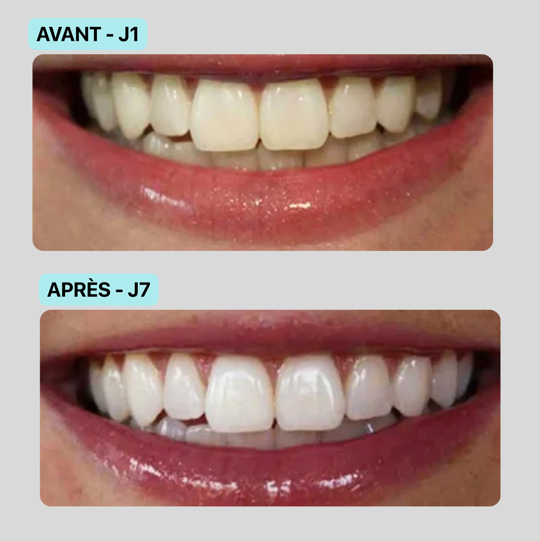 Stylo Sérum Anti-taches – Blanchisseur de dents l 1 Acheté = 1 Offert